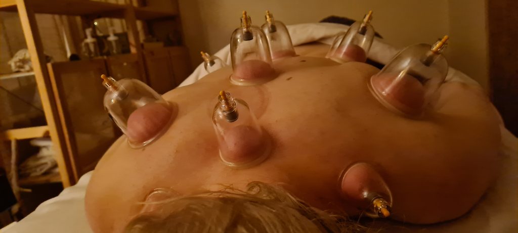 Cupping behandling på ryg